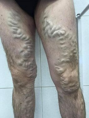 vernachlässigte männliche Krampfadern
