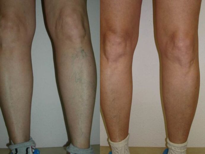 Beine vor und nach Krampfader-Laserbehandlung