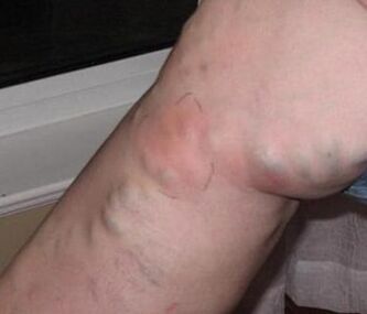 Thrombophlebitis im Bein mit Krampfadern. 