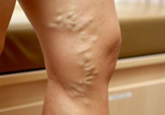 Krampfadern in den Beinen einer Frau. 