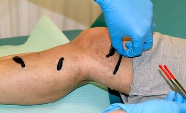 Hirudotherapie bei Krampfadern