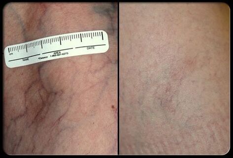 Vor und nach dem Lasertherapieverfahren
