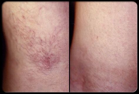 Vor und nach der Sklerotherapie